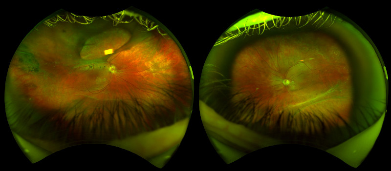 retinal images